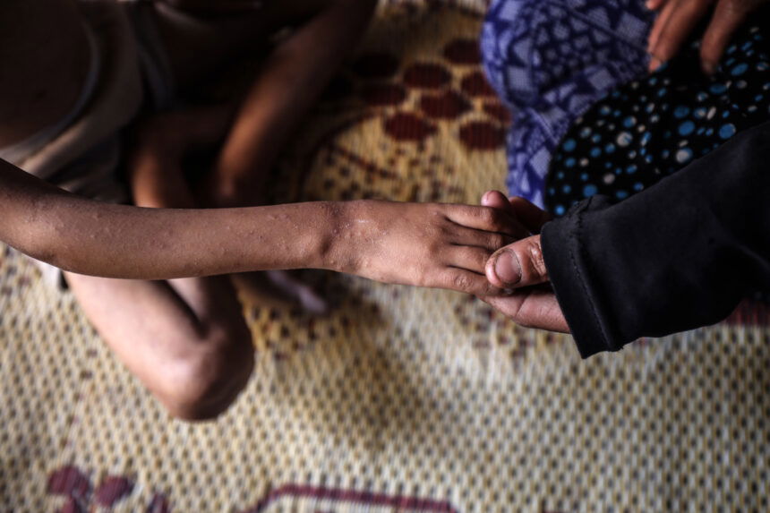 Malnutrition photo in Gaza