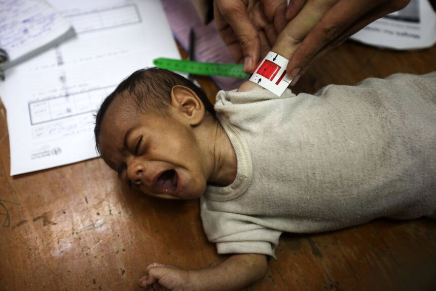 photo of Malnutrition In Gaza